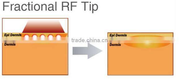 Facial resurfacing acne scar removal treatment fractional rf