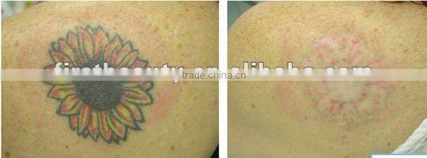 Nd. Yag laserlaser tattoo removal machine D001 China mianland manufacture
