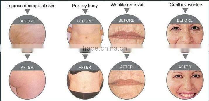 korea rf skin tightening machine