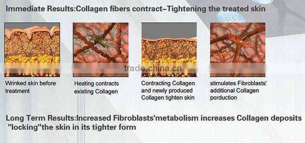 Professional RF Skin Treatment Cavitation Liposuction