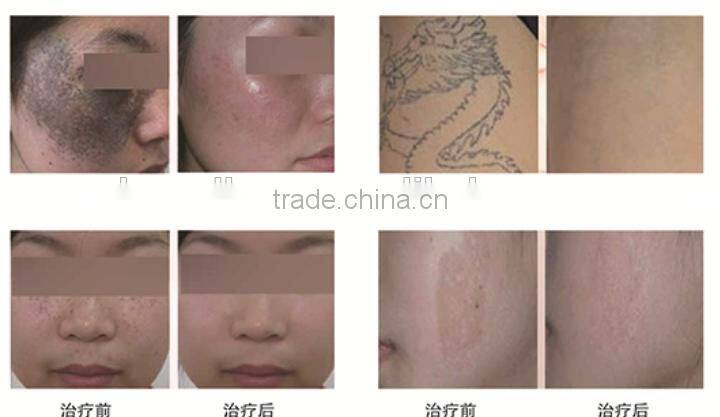 New design nd yag laser price nd yag with great price