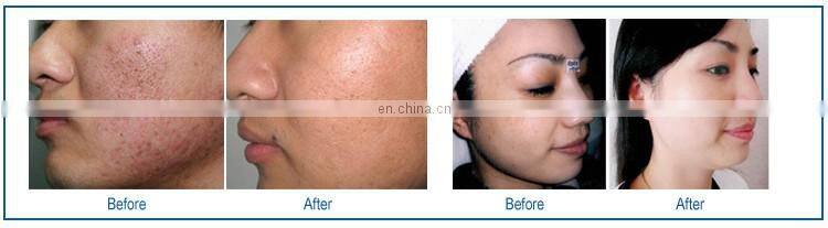 guangzhou renlang fractional laser co2 fracionado vaginal tightening machine for sale