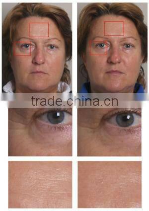 Portable Electrophoresis Needle Free Machine