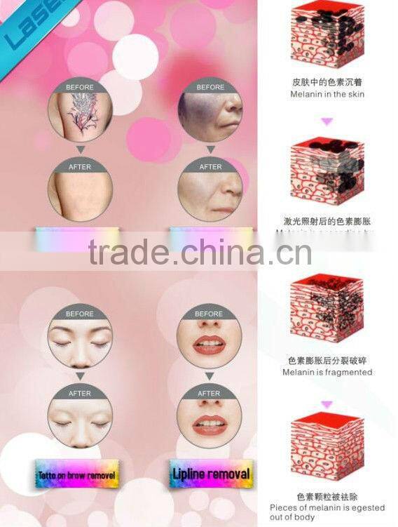 nd yag laser q switch/nd yag laser beauty machine/nd yag laser