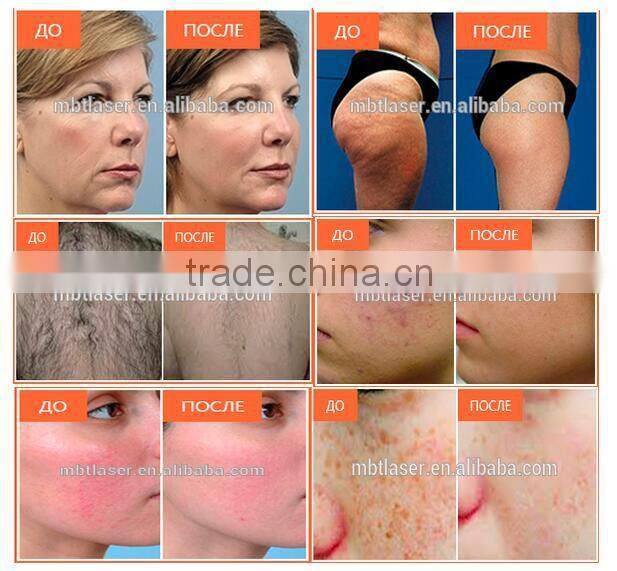 NEW MBT K8 With medical CE ISO GOST-P SHR + Elight + IPL + RF hair removal Machine