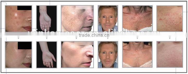 general surgery and plastic surgery co2 laser machine