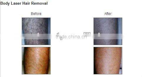 Optimal Pulse Technology Permanent Hair Reduction E-light C001