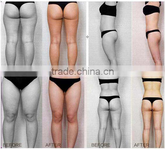 Safety ultrasound slimming weight loss fat reduction liposunic machine price