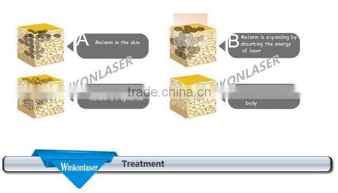 Factory supply home nd yag laser/ tattoo removal treatment