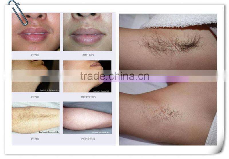 IPL SHR laser hair removal machine with touch screen