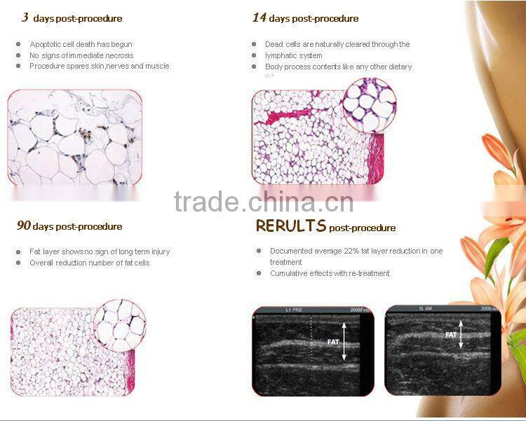 Newest cryo handle working cold lipolysis lipo laser fat loss machine for salon use