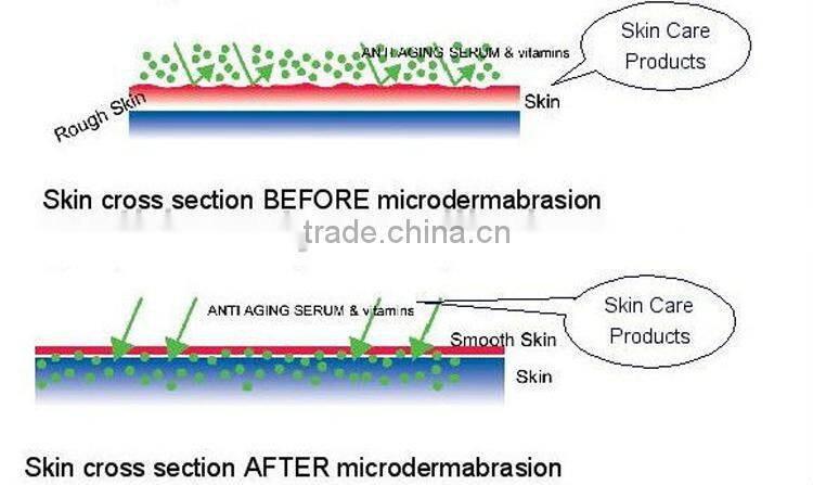 Hot sale Portable 4 in 1Dermabrasion and microdermabrasion device for pigmentation corrector