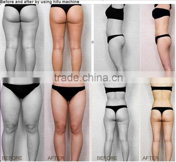 Breast Enhancers , Cellulite Reduction Feature weight loss slimming liposonic machine