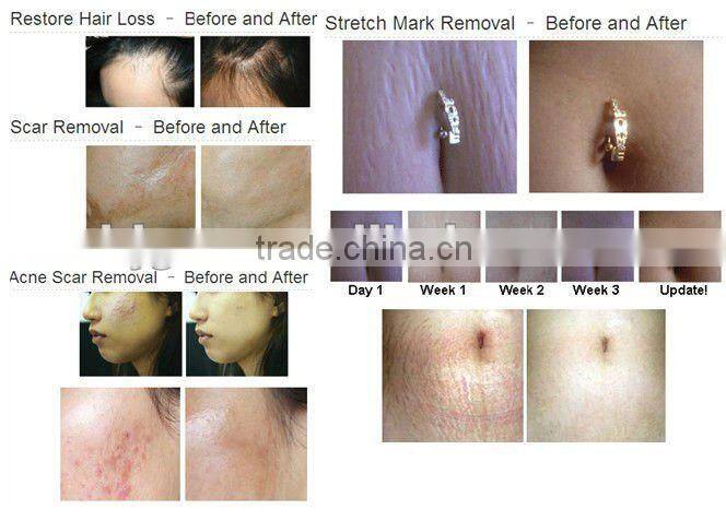 Professional for Hyper Pigmentation Treatment,wrinkle removal,wonderful personal care tool,LED derma roller(CE approved)