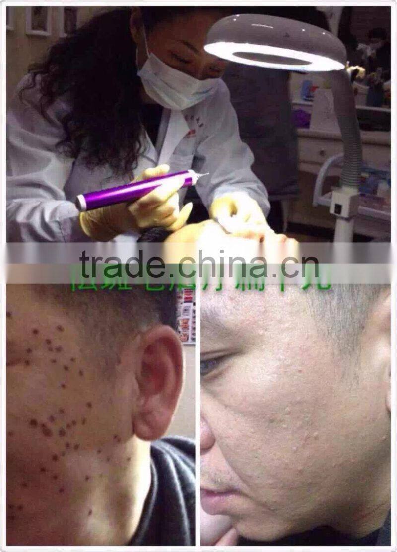 2015 New Wholesale Professional mini Tatoo Spot Mole Laser Remover freck spot removal laser pen