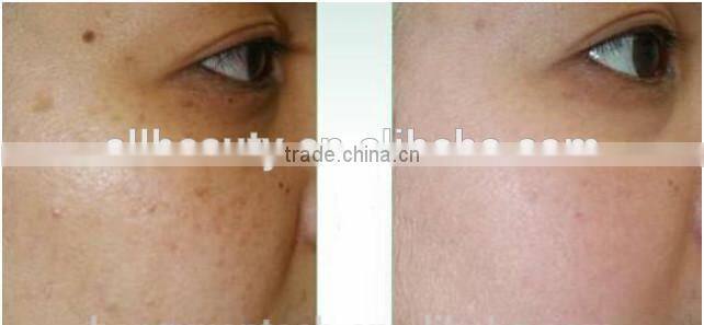 Beauty (CE certificate) USA RF tube Fractional CO2 laser vaginal tightening