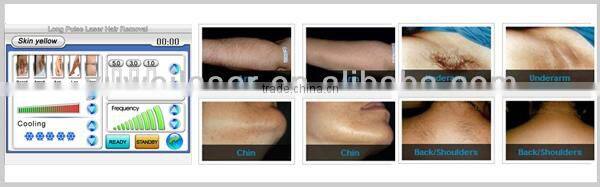 professional salon equipment long pulse Nd:YAG laser to remove tattoo