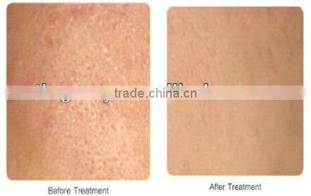 Skin Tighten Dema Roller Skin Care