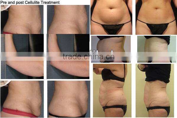 Portable vacuum roller machine cellulite roller massage