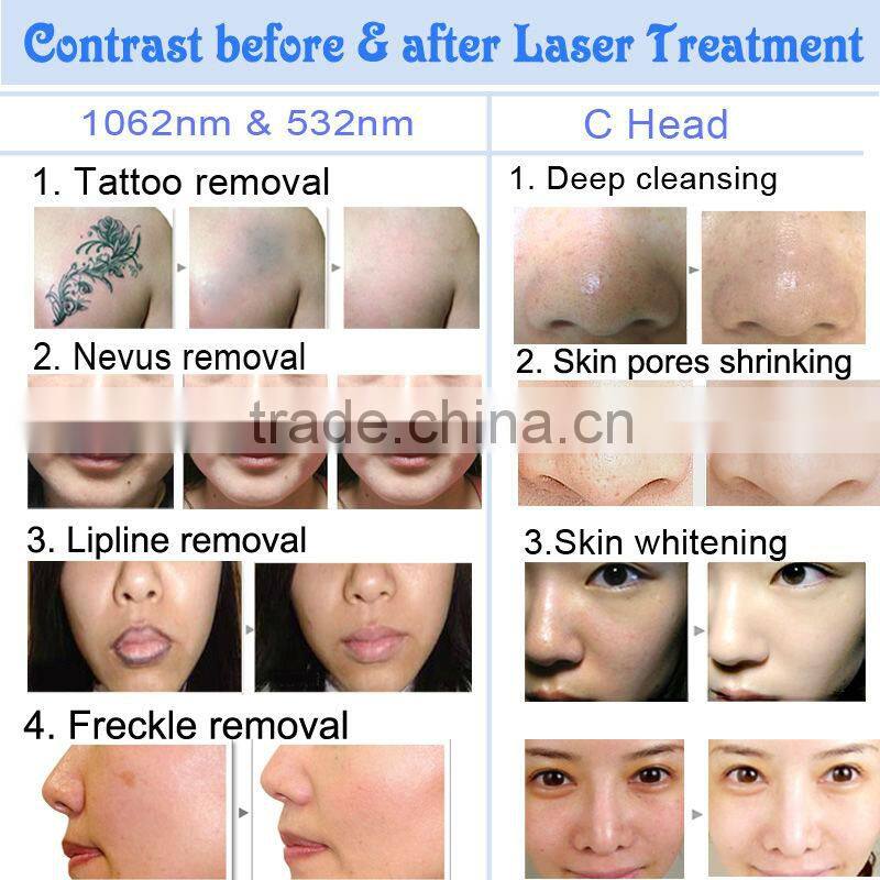 3 IN I Laser Tattoo Removal Machine RF Machine IPL Hair Removal Multifunctional Beauty Salon Equipment OD-IRL10