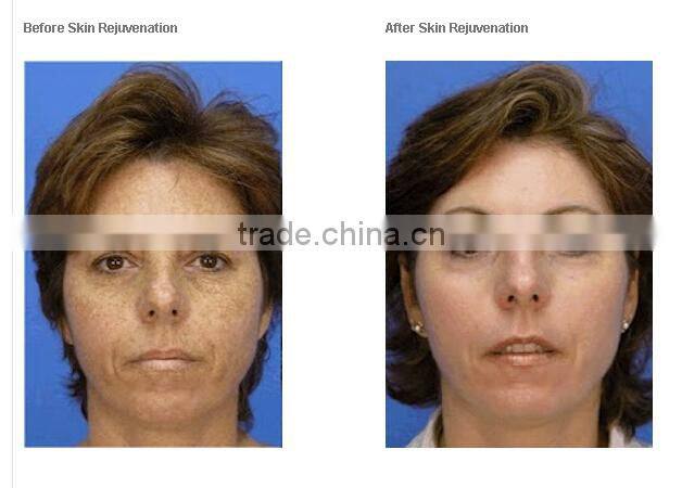 Mini IPL Skin Rejuvenation Machine/ Best Permanent Hair Removal IPL Beauty Device