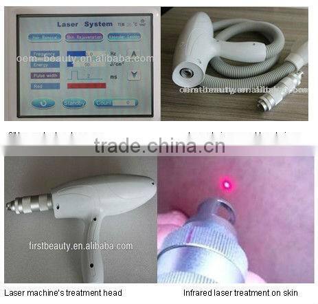 Personal Pain Free Nd Yag laser hair remover and onychomycosis removal