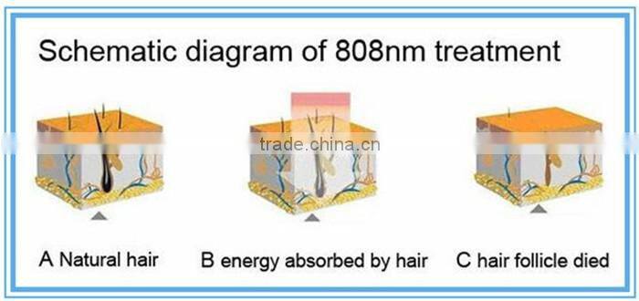 2016 Distributor wanted permanent hair removal shr hair removal 808nm diode laser