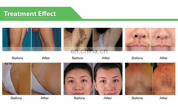 Laser Diode 808 nm/ Laser Diodo 810 nm/ Professional Diode Laser Hair Remover