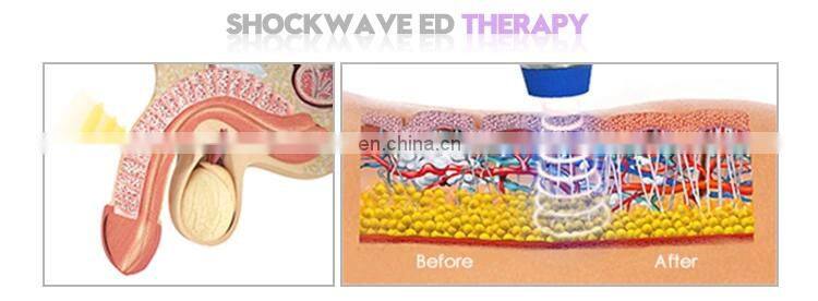 Portable machine  Low intensity shock wave therapy erectile for ed