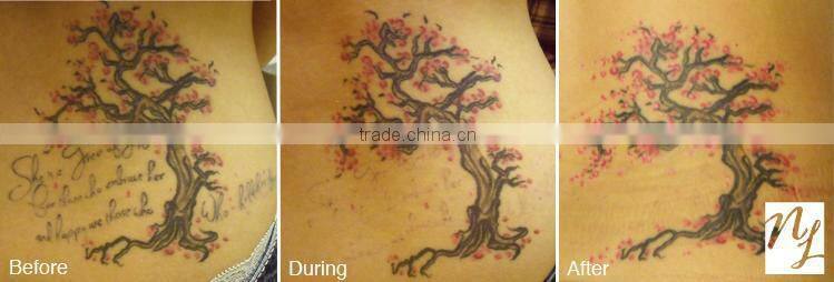 Professional Q-switch ND YAG Laser