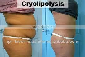 tripolar rf cavitation/cavitation cellulite treatment/ultrasonic liposuction cavitation machine for sale