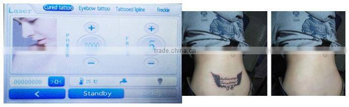 2016 china laser beauty equipment Q-switched nd yag laser tattoo removal 1320nm black doll for salon use