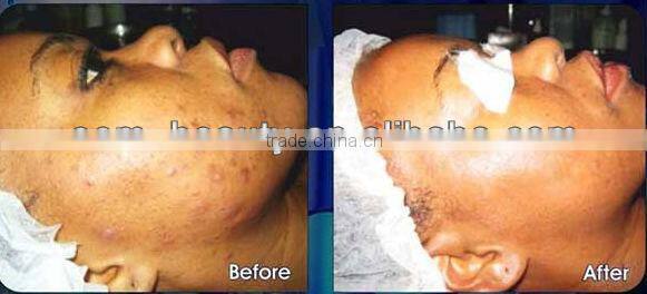 IPL machine for hair removal, freckle removal with Memory battery in the handpiece-(FB-A006)