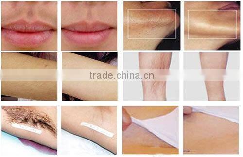 beauty salon use for skin rejuvenation hair removal machine