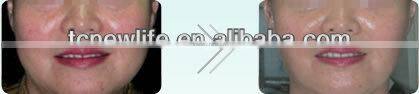 NL-TM800/ Guangzhou Newlife factory/newest design/ RF skin rejuvenation machine/fractional RF