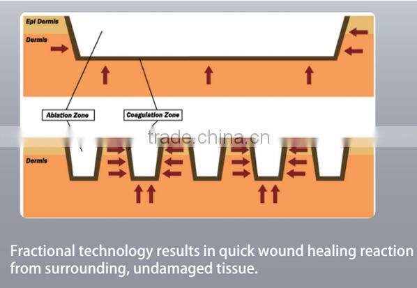 2016 non-invasive thermagic microneedle fractional rf for anti wrinkle