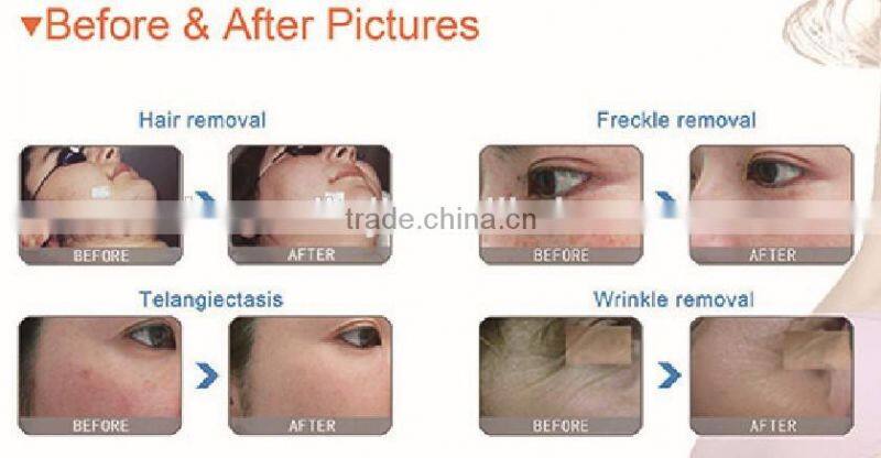 Distributors Wanted Full Body Hair Removal Machine Portable IPL