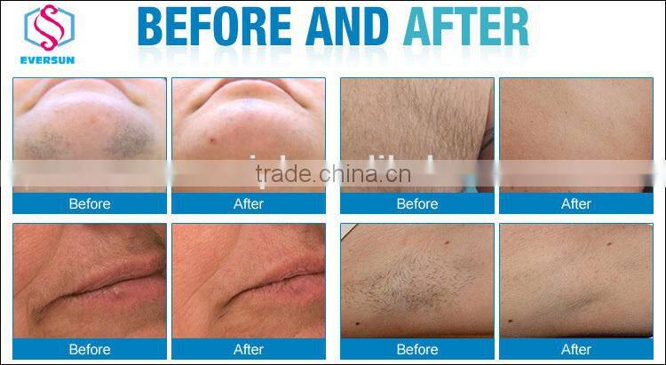 Factory Direct Wholesale 808nm laser hair removal laser laser beauty equipment