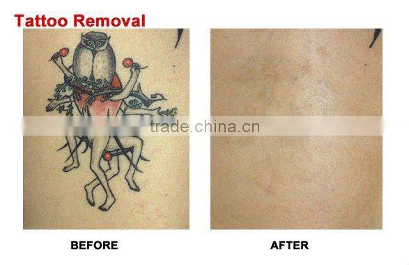 new high energy Q-switched ND YAG laser tattoo removal machine