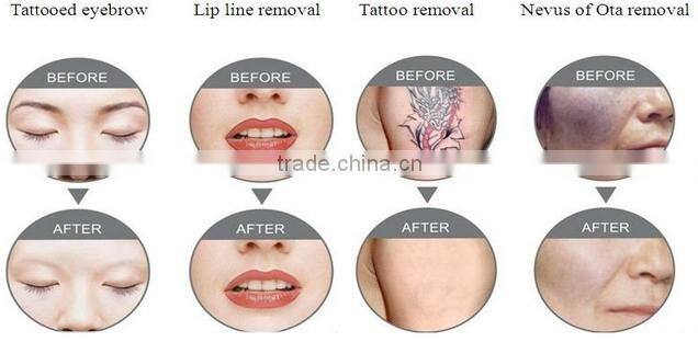 2014 Hottest sale q-switched nd yag laser tattoo removal machine nd yag laser korea