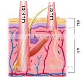 2015 new arrival first class cheap portable laser machine for tattoo removal