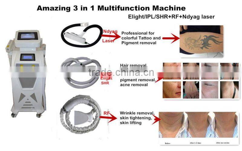 ipl (rf +yag) shr elight laser hair removal machine