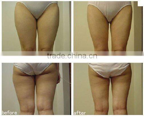 New beauty machine bipolar RF/slimming/ Ultrasonic liposuction/ Bio facial machine