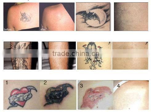 laser tattoo removal victory