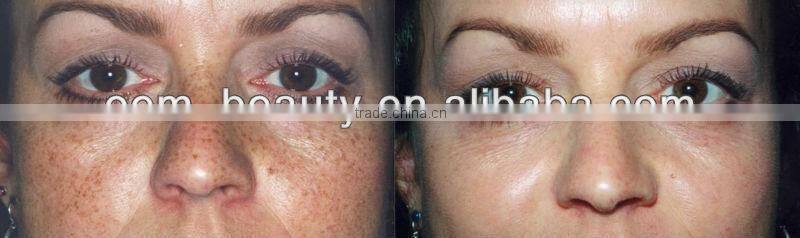 epilator pulsed light ipl skin rejuvenation machine A003