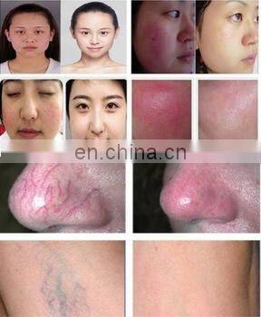 2019 vascular spider removal 980 nm laser beijing Anybeauty manufacturer