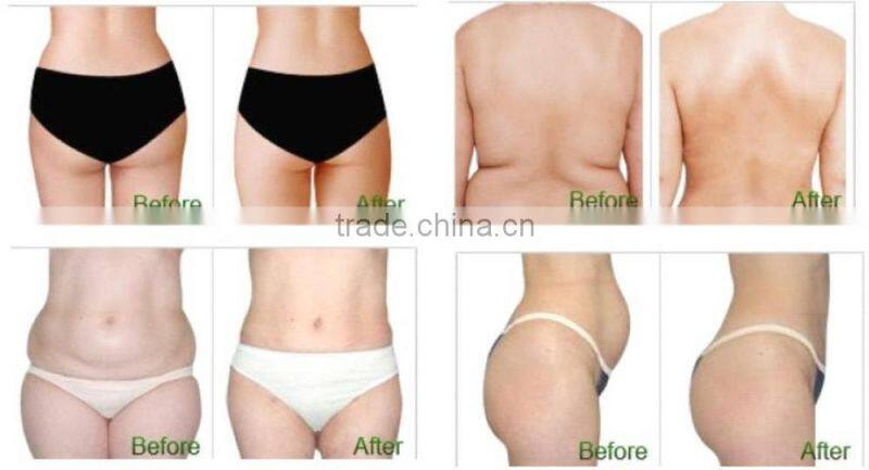 home use cryolipolysis machine for fat removal cryo machine