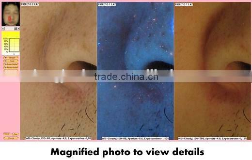 Hot-selling made in China smart system digital dermatoscope professional portable 3d skin analyzer
