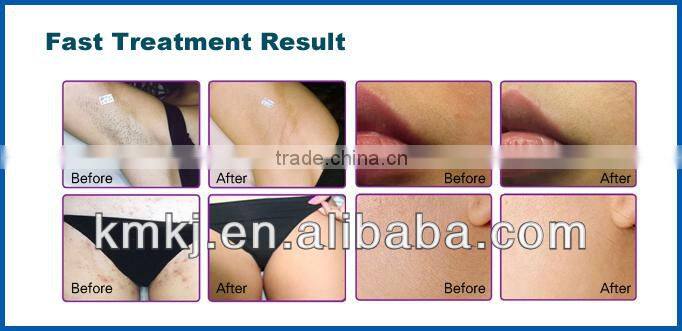 high power no pain 808nm permanent hair removal for salon