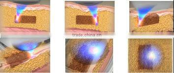 China Manufacturer Weight Loss Equipment Body Slimming Machine Liposonix for Salon Use